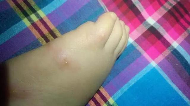 夏季蟲咬急救攻略，家有孩子的更要看看