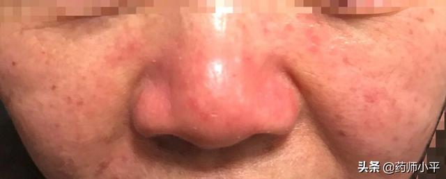 面部發(fā)紅癢癢、反復過敏，可能是在提醒做這一件事情，該清除螨了