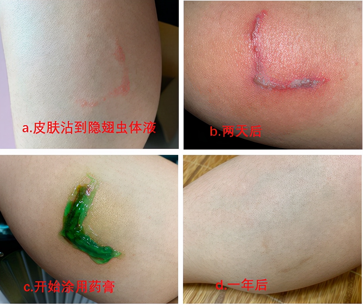 隱翅蟲(chóng)的毒性有多強(qiáng)？體液比眼鏡蛇更毒，捕蠅草吸收它都會(huì)枯萎