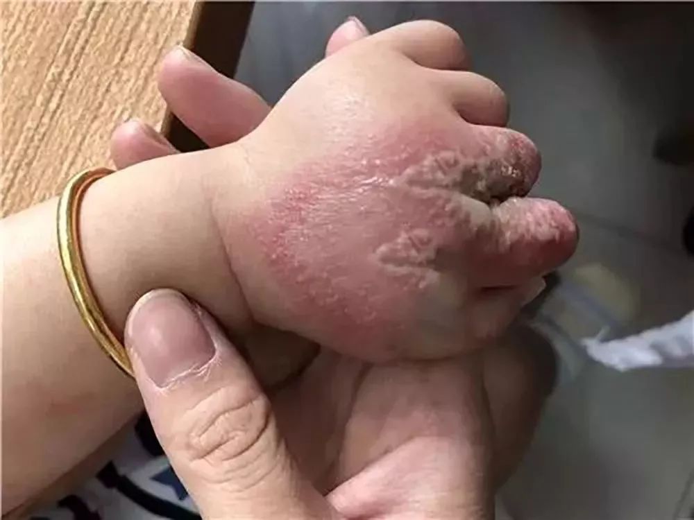 隱翅蟲(chóng)的毒性有多強(qiáng)？體液比眼鏡蛇更毒，捕蠅草吸收它都會(huì)枯萎